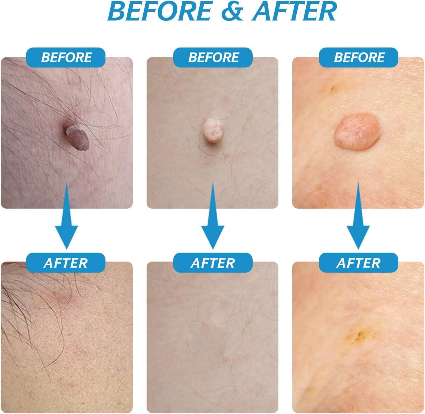 2 in 1 Skin Tag Remover Kit - Painless